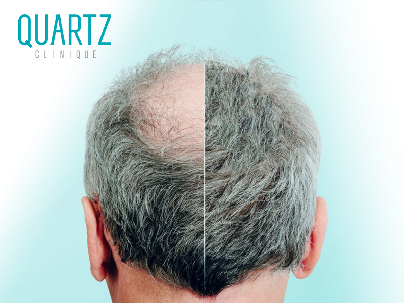 crown hair transplant