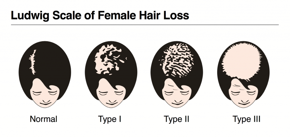 ludwig scale of hair loss