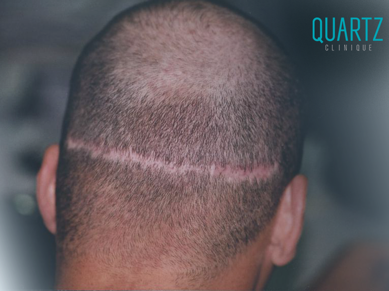 Hair Transplant Scar