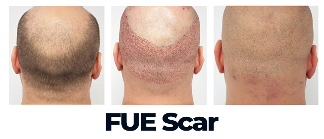 Hair Transplant Scar 8 fue scar
