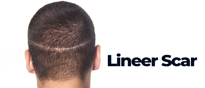 Hair Transplant Scar 7 lineer scar fut