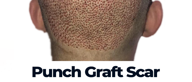 Hair Transplant Scar 9 punch graft scar