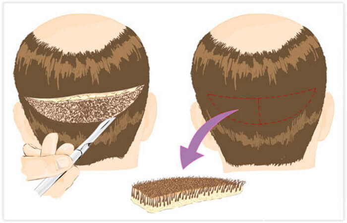 تقنية زراعة الشعر بالشريحة 3 تقنية زراعة الشعر بالشريحة