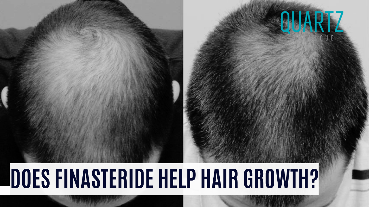 Does Finasteride Help Hair Growth