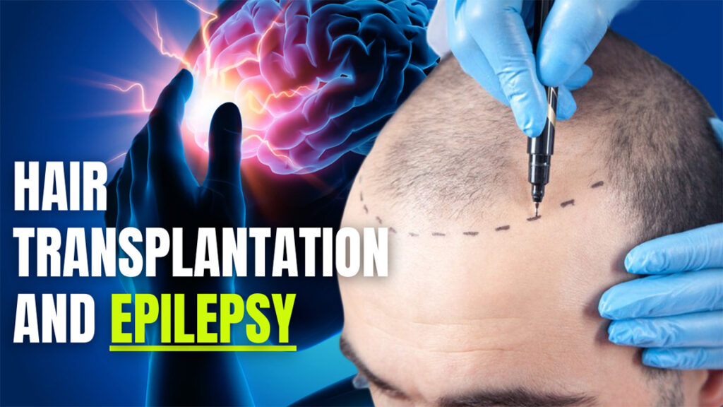 Hair Transplantation And Epilepsy