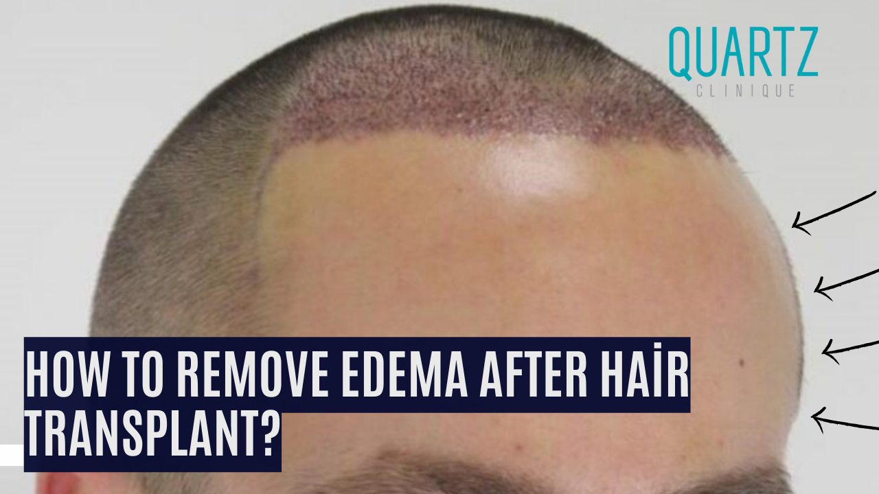 How To Remove Edema After Hair Transplant