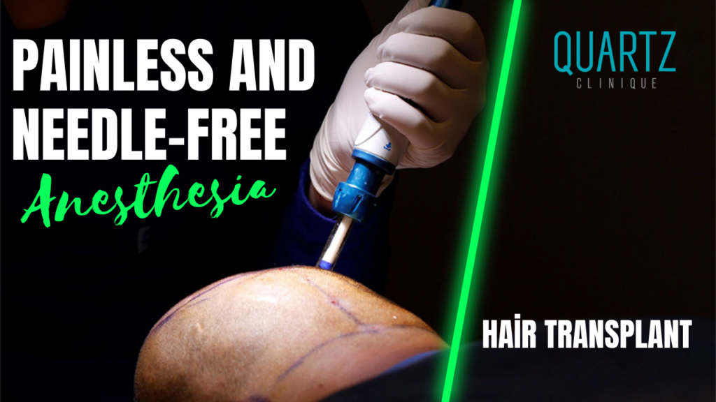Painless and Needle-Free Hair Transplant