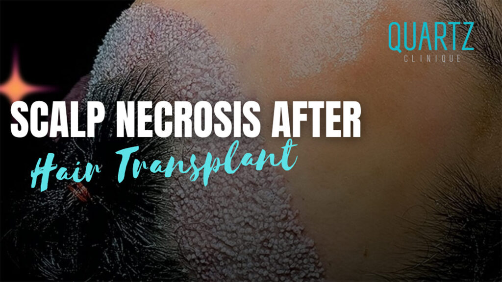 Scalp Necrosis After Hair Transplant