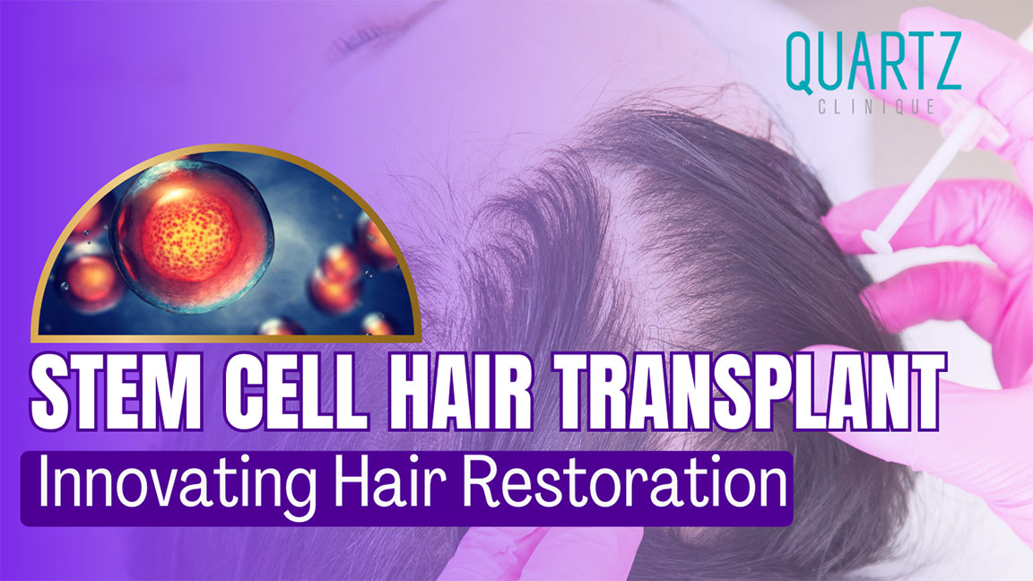 Stem Cell Hair Transplant