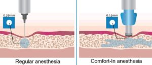 Painless and Needle-Free Hair Transplant 