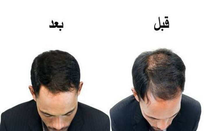 حبوب فيناسترايد للشعر و دوتاستيريد 3 حبوب فيناسترايد للشعر
