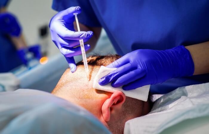 الالم بعد زراعة الشعر 3 الالم بعد زراعة الشعر