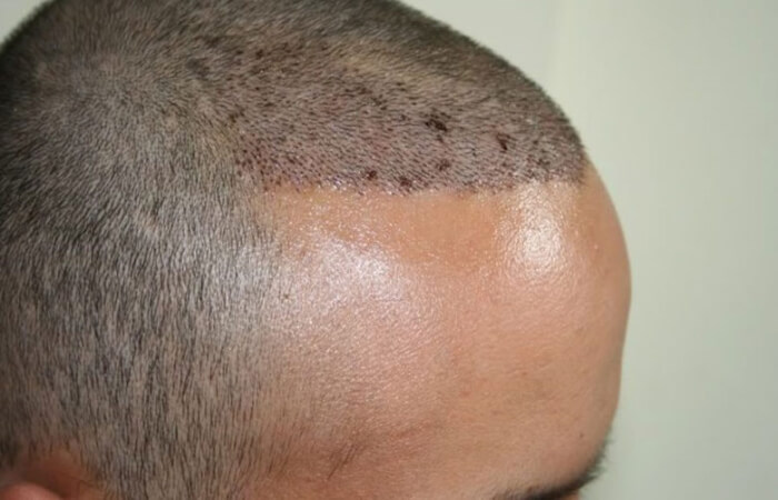 تورم الرأس بعد زراعة الشعر 3 تورم الرأس بعد زراعة الشعر