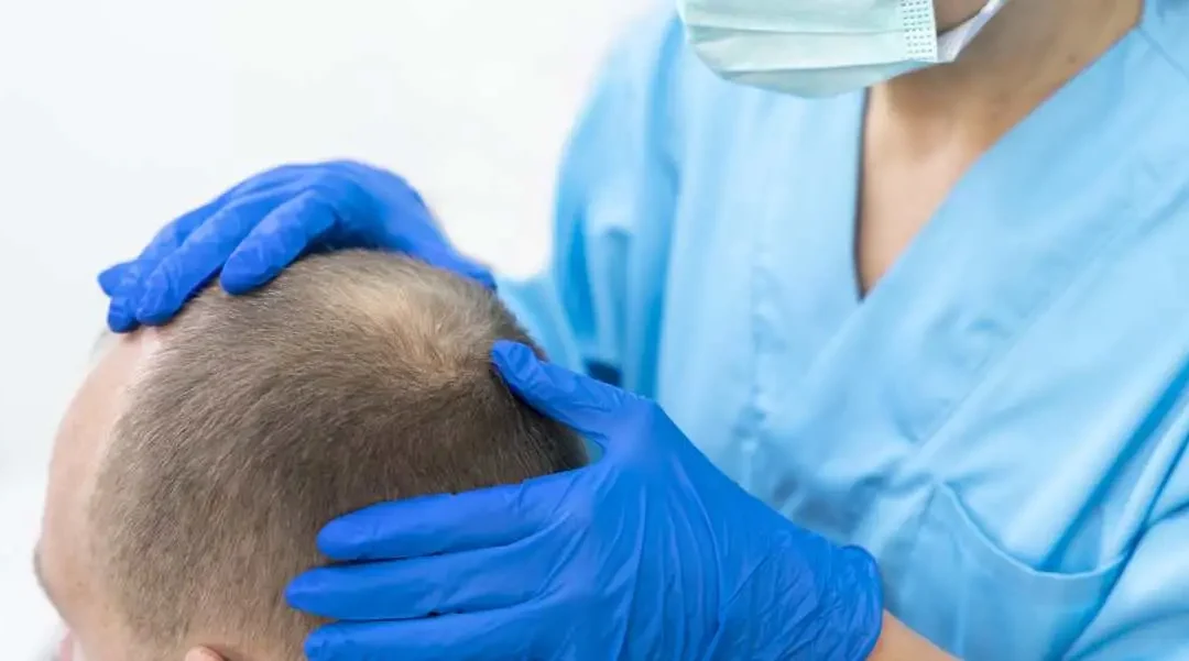 Considerations After Hair Transplantation