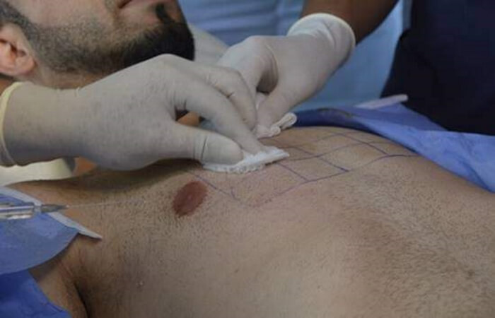 زراعة الشعر باستخدام شعر الجسم 2 زراعة الشعر باستخدام شعر الجسم - كوارتز هير - اسطنبول