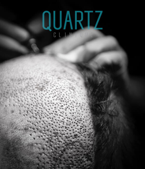 أهم الاسئلة الشائعة حول زراعة بصيلات الشعر - كوارتز هير - اسطنبول