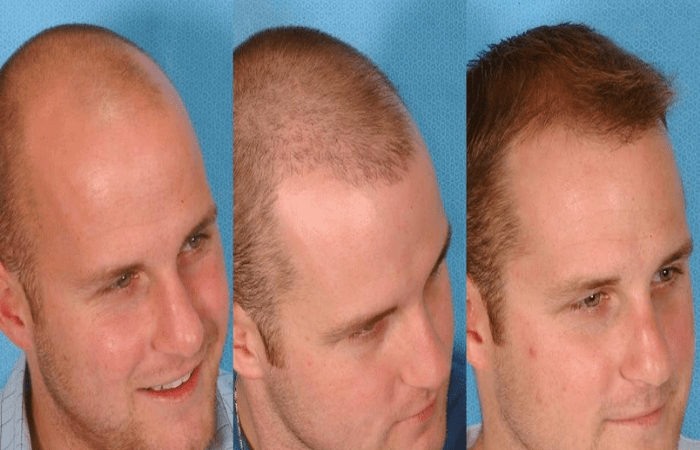 مراحل نمو الشعر المزروع