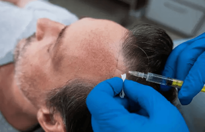 الاكسوزوم بعد زراعة الشعر - كوارتز هير - اسطنبول