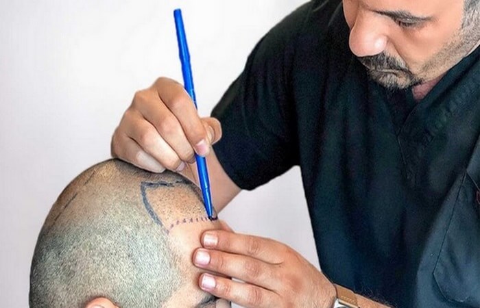 تقنيات زراعة الشعر - الفرق بين تقنيات زراعة الشعر - كوارتز هير - اسطنبول