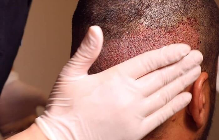 تدليك الرأس بعد زراعة الشعر - كوارتز هير - اسطنبول