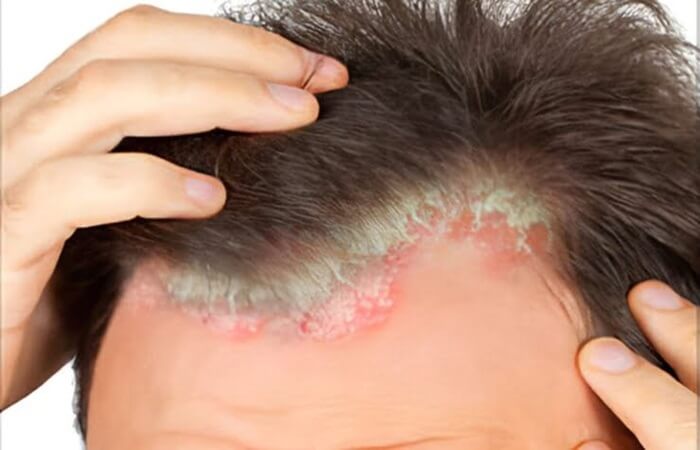 زراعة الشعر لمرضى الصدفية - كوارتز هير - اسطنبول
