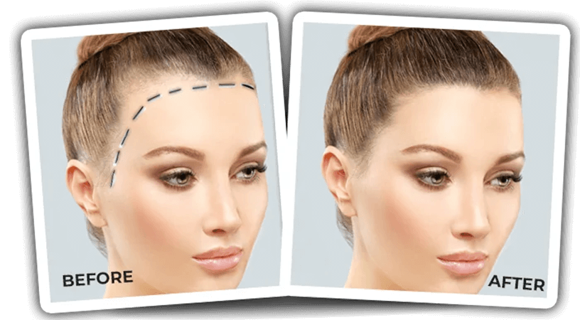 تضييق الجبهة بزراعة الشعر - كوارتز هير - اسطنبول