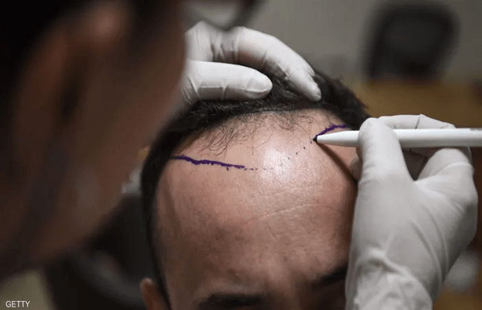 زراعة الشعر لمرضى الصرع
