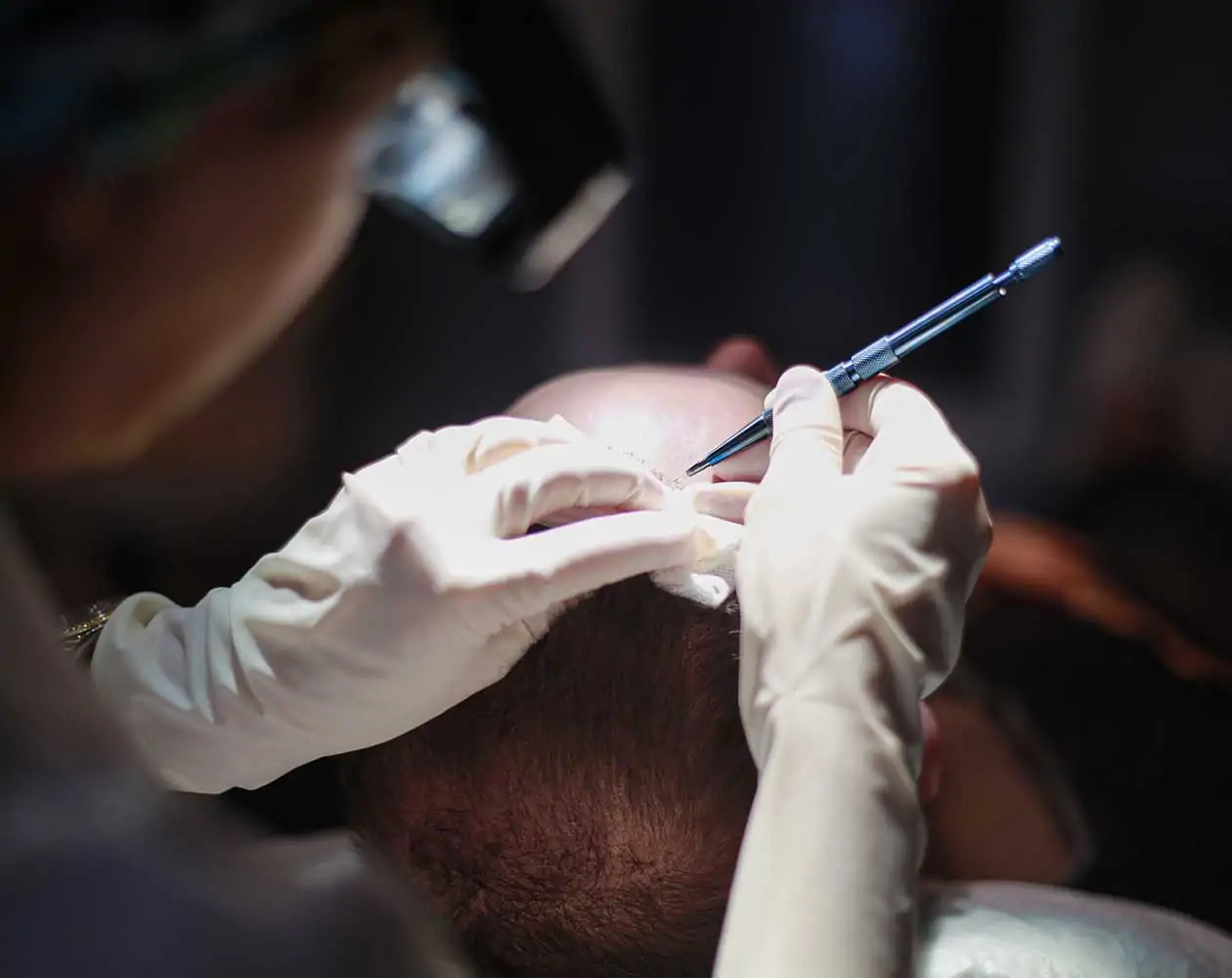 sapphire fue hair transplant.jpeg1