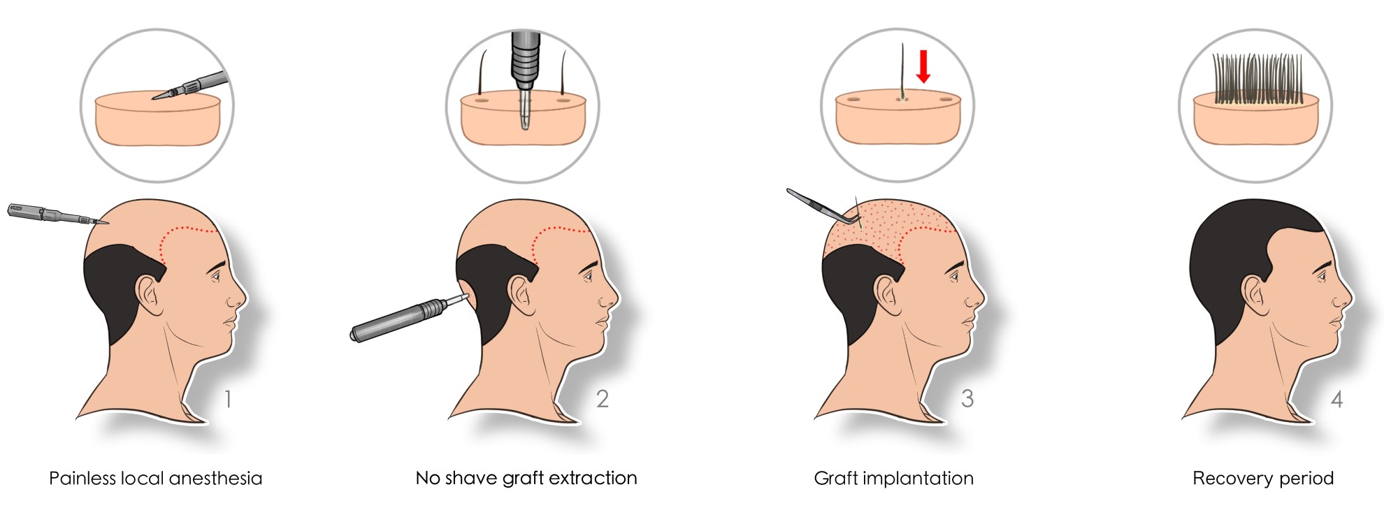 hair transplant 5000greft
