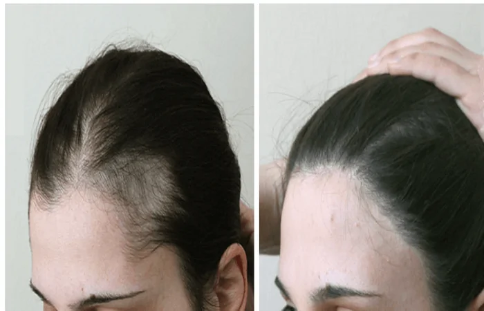 عملية زراعة الشعر للنساء | الطريقة النتائج الشفاء | اسطنبول