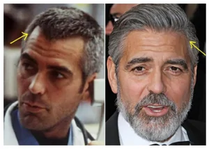 George-Clooney-hair-transplant