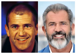 Mel-gibson-hair-transplant