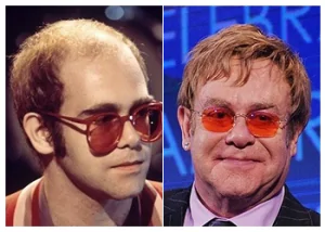 elton-john-hair-transplant