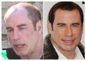 john-travolta-hair-transplant