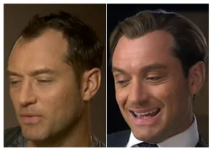 jude-law-hair-transplant