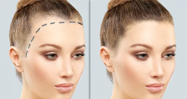 Forehead Reduction (Hairline Lowering)