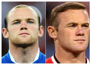 wayne-rooney-hair-transplant