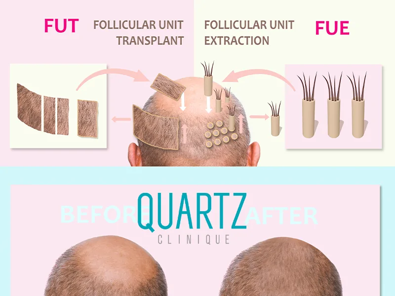 Follicular unit transplant (FUT)