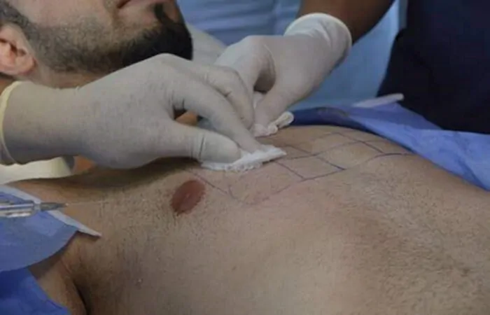 زراعة الشعر باستخدام شعر الجسم 3 زراعة الشعر باستخدام شعر الجسم - كوارتز هير - اسطنبول