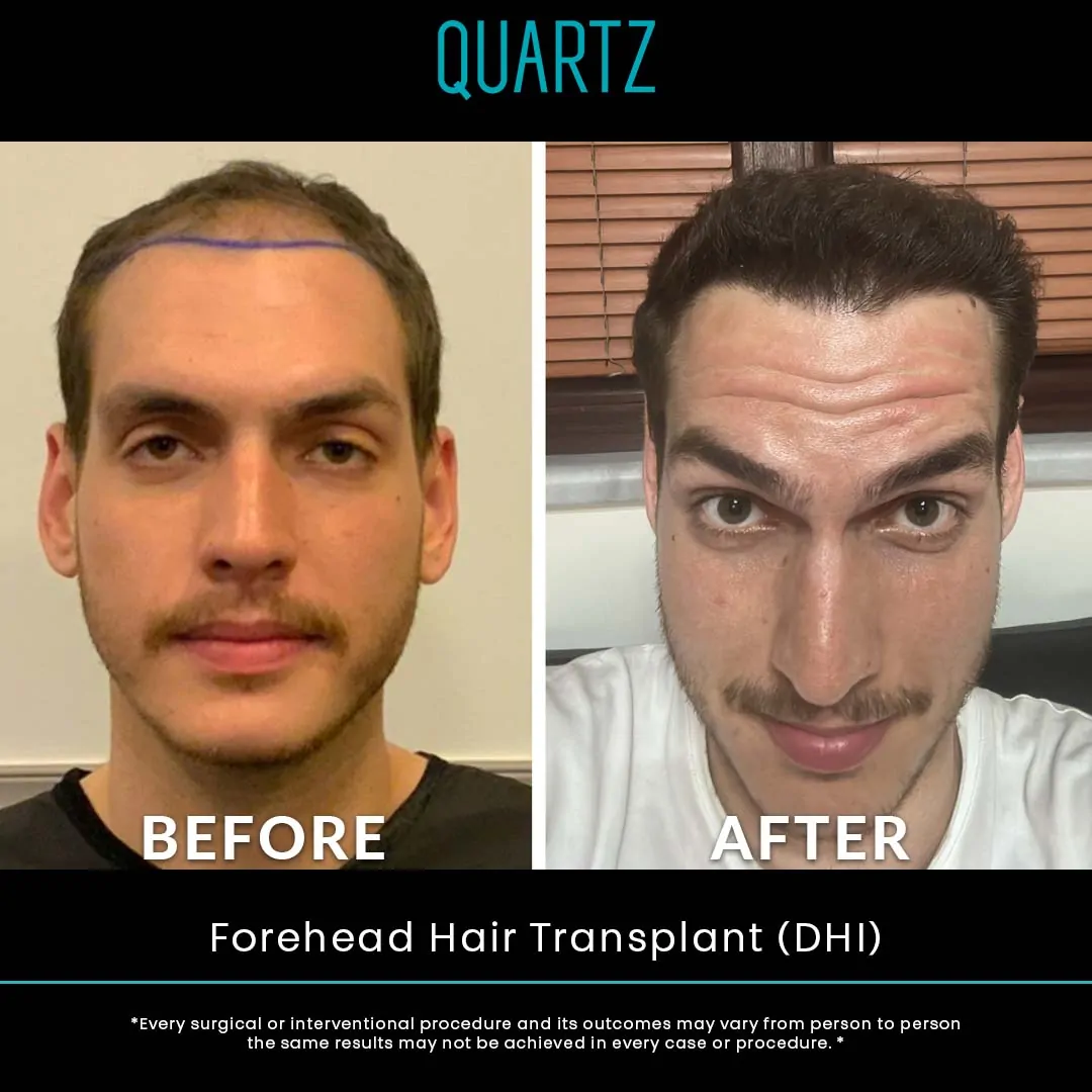 Hair Transplant Turkey 11 Sac Ekim Before After 14