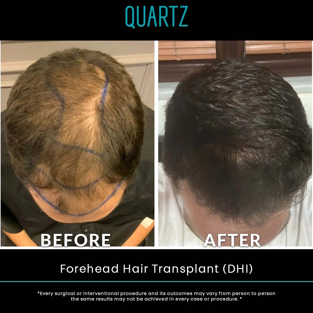 Hair Transplant Turkey 12 Sac Ekim Before After 15