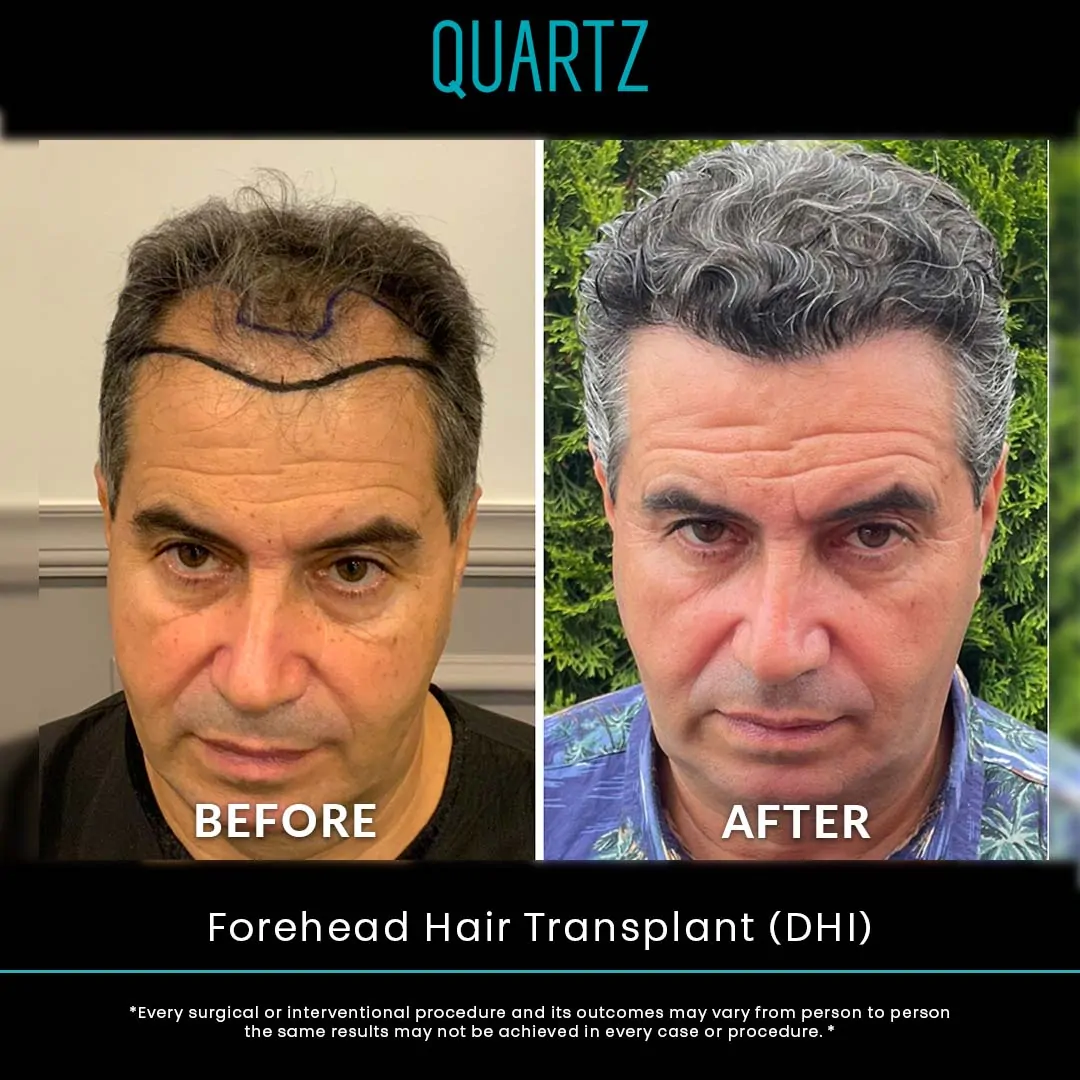 Hair Transplant Turkey 10 Sac Ekim Before After 3