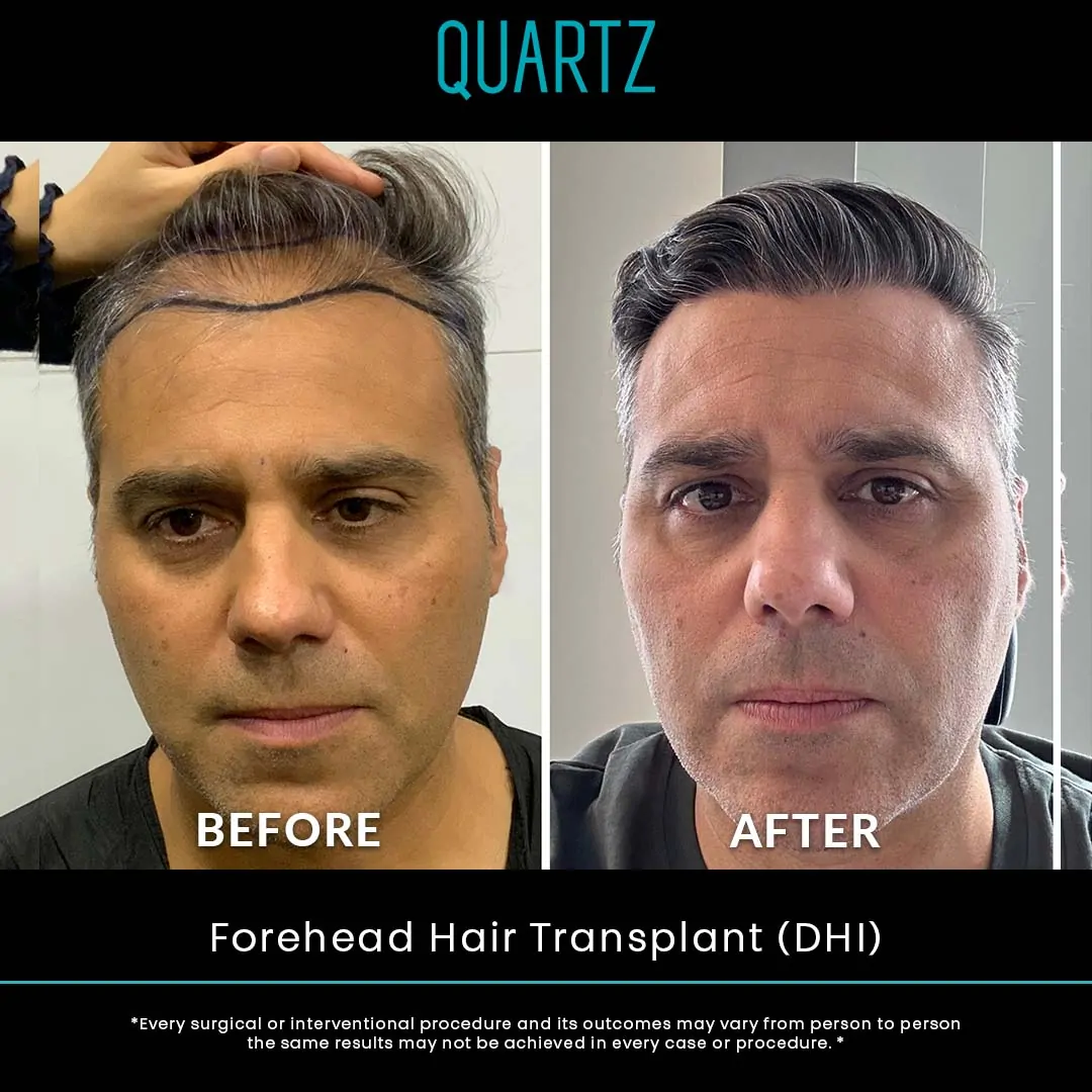 Hair Transplant Turkey 9 Sac Ekim Before After 4