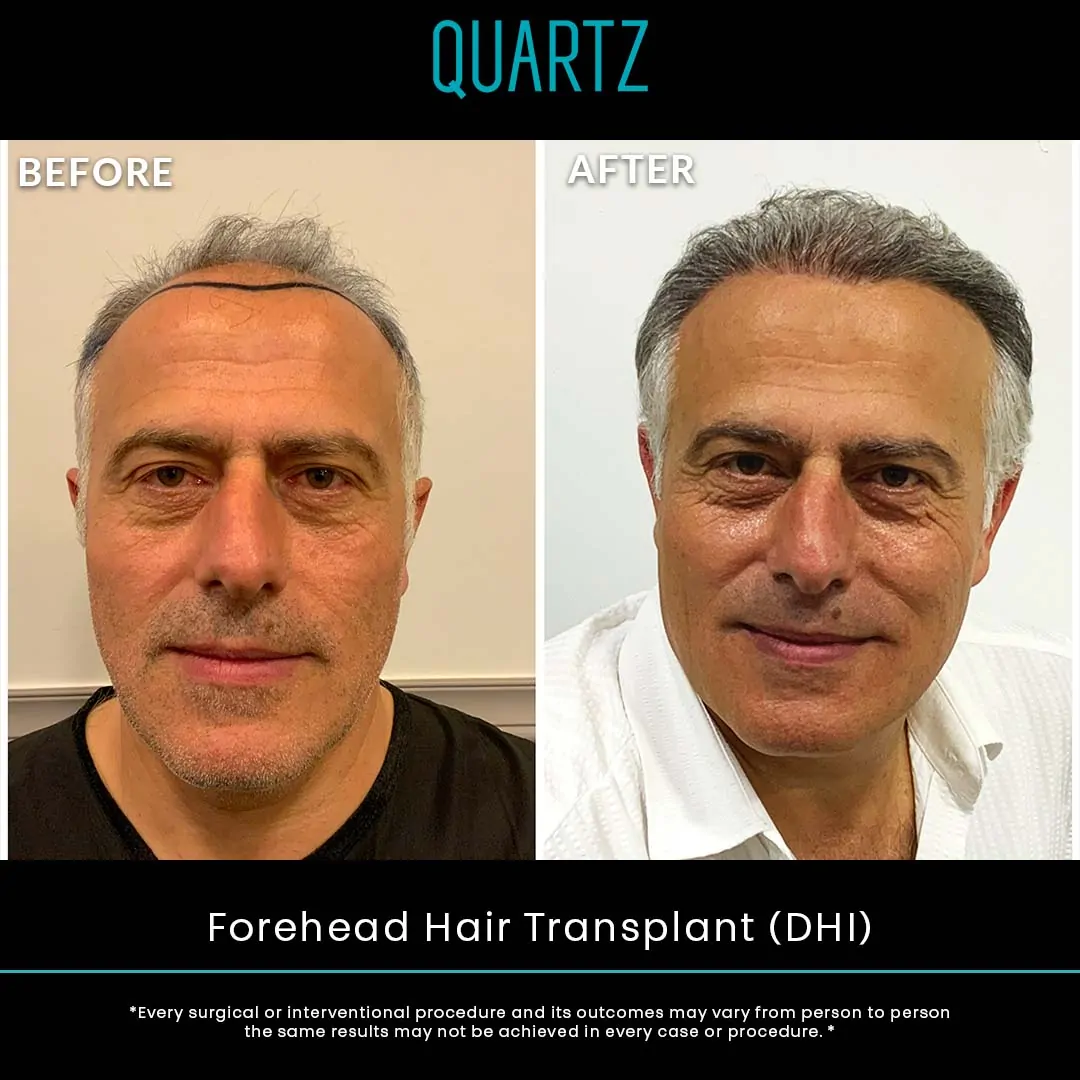 Hair Transplant Turkey 8 Sac Ekim Before After 9