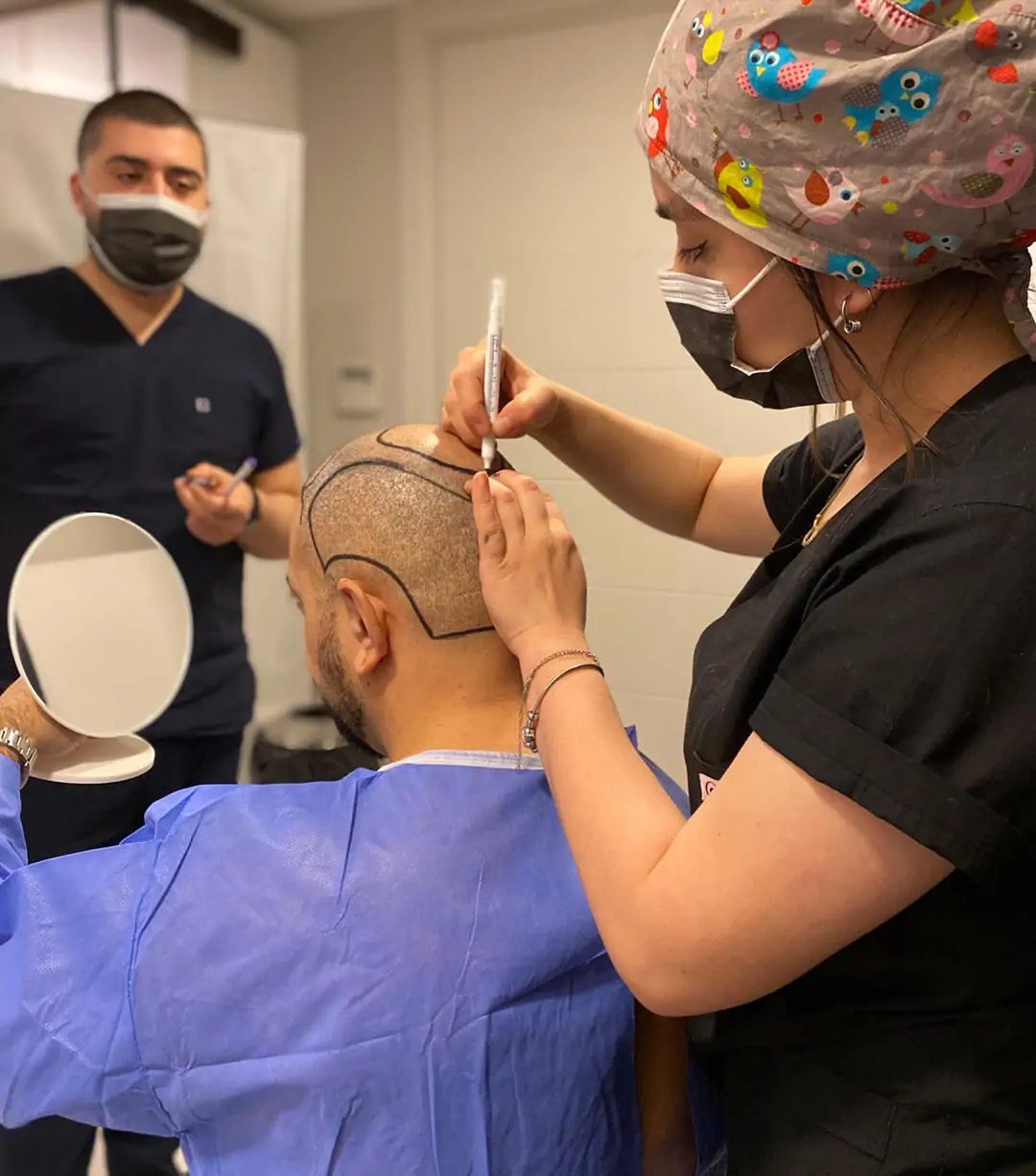 زراعة الشعر في تركيا 22 hair transplant plan 1