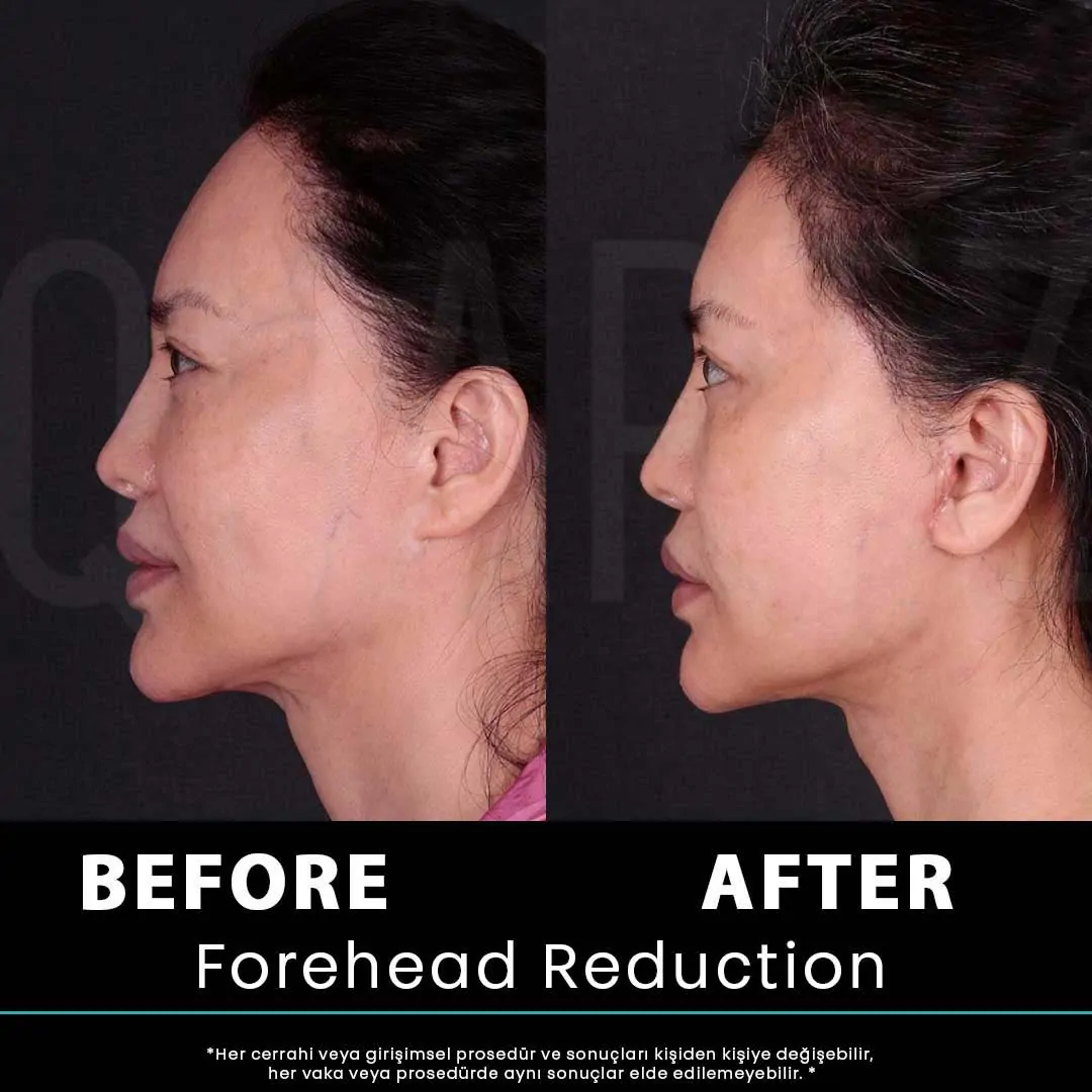 Hair Transplant Turkey 17 kadin 17