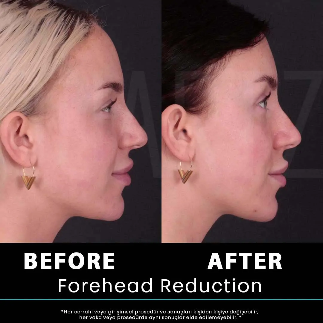 Hair Transplant Turkey 13 kadin 23