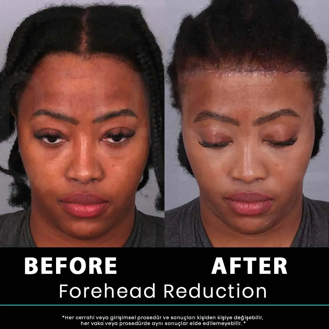 Hair Transplant Turkey 14 kadin 25