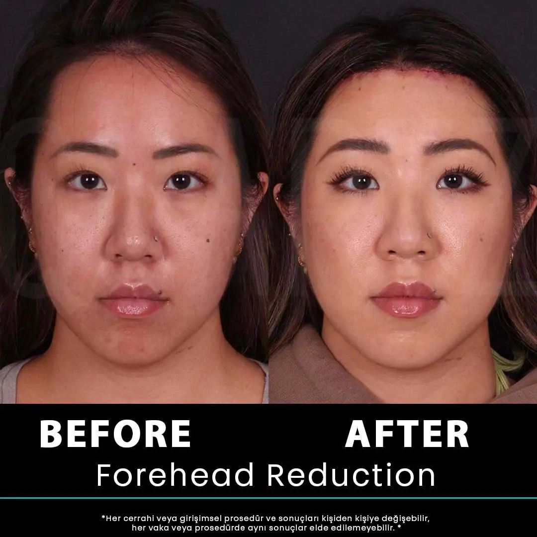 Hair Transplant Turkey 15 kadin 31