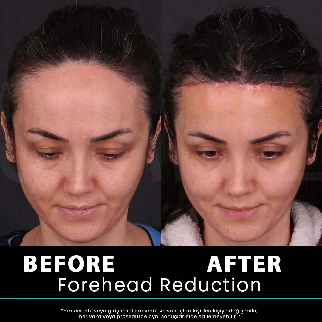 Hair Transplant Turkey 16 kadin 43